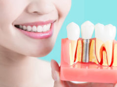 Что представляет собой дентальная имплантация?