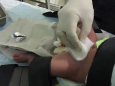 Виды операций по обрезанию крайней плоти