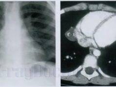 Рентгенологическое исследование грудной клетки и сердца