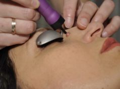 Удаление кератом лазером