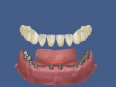 Что собой представляет базальная имплантация зубов?