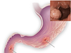 Эффективное лечение язвы желудка