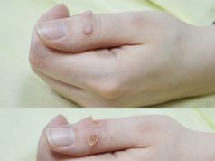 Как обрабатывать рану после удаления бородавки?