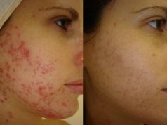 Мучает акне? Мезотерапия — оптимальное решение вашей проблемы