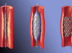 Как проводится стентирование сосудов сердца?