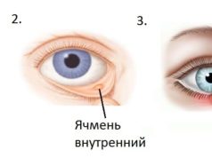 Как быстро вылечить ячмень на глазу?
