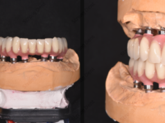 Протезирование зубов: плюсы