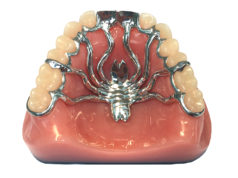 Протезирование зубов: плюсы