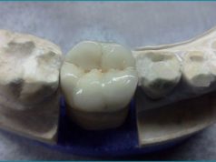 Особенности металлокерамических коронок