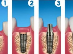 Этапы имплантации зубов