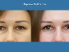 Как выбрать хирурга по пластике век?