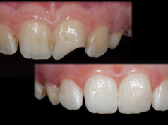 Виды реставрация зубов