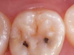 Причины и профилактика возникновения кариеса