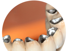 Виды металлокерамических коронок