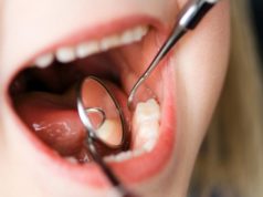 Нужно ли удалять зубы мудрости