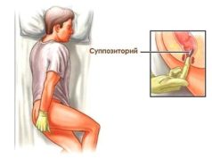Способ применения ректальных суппозиториев