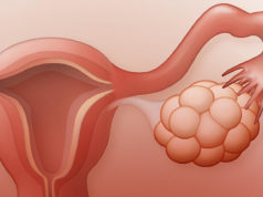 Синдром поликистозных яичников: особенности диагностики