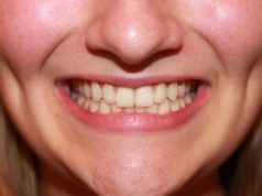 Проблемы с зубами из-за веганства?