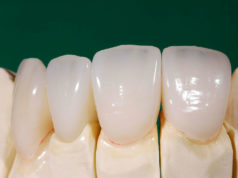 Преимущества безметалловых коронок