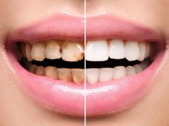 Эстетическая реставрация зубов: показания, способы, этапы