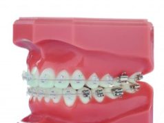 Использование керамических брекетов для исправления прикуса