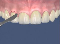 Восстановление десен: пластика мягких тканей полости рта
