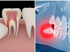 Почему приходится удалять зуб