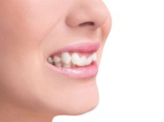 Что будет если не исправлять прикус?