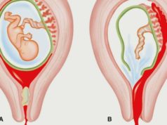 Медикаментозный аборт — что это такое и в чем его преимущества