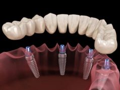 Современные способы протезирования зубов
