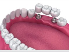 Преимущества 3D технологии в протезировании зубов