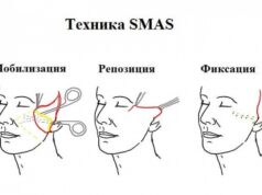Минус 15 лет благодаря SMAS-подтяжке