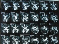 Что показывает МРТ сосудов головного мозга?