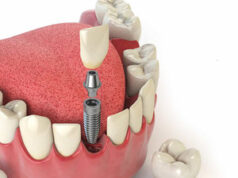 Протезирование зубов: актуальная стоимость, цели, показания к применению