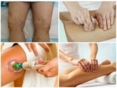 Техника проведения антицеллюлитного массажа