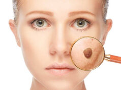 Где безопасно удалить невус?