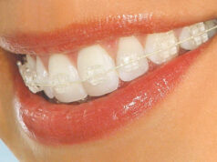 Сапфировые брекеты: все за и против