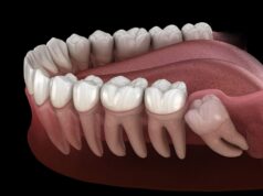 Зубы мудрости: показания к удалению