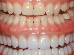 Реставрация зубов: показания и противопоказания