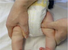 Тонкости проведения лечения косолапости по методу Понсети