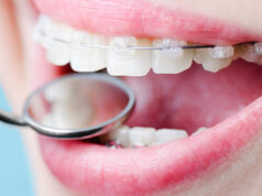 Сколько необходимо носить брекеты?