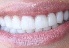 Виниры: залог голливудской улыбки