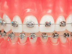 Показания к установке брекетов