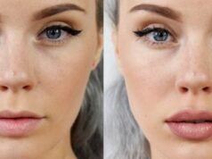 Филлеры: применение в косметологии