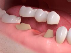 Преимущества имплантологии Белой стоматологии