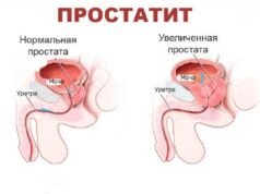 Что такое простатит и каковы его симптомы?