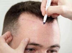 Безопасный и эффективный FUE метод пересадки волос: особенности и главные достоинства