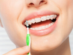 Основные преимущества безлигатурных керамических брекетов