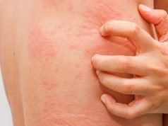 Аллергия: на что может быть?