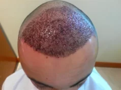 Особенности пересадки волос